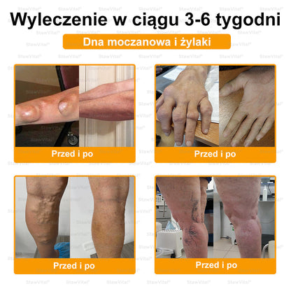 𝑺𝒕𝒂𝒘𝑽𝒊𝒕𝒂𝒍® Krem z jadem pszczelim na regenerację stawów 🏃‍♀️ (ekstrakt z pszczoły nowozelandzkiej – opracowany z myślą o osobach z problemami ze stawami i bólem stawów)