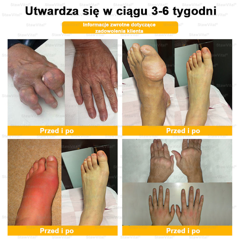 𝑺𝒕𝒂𝒘𝑽𝒊𝒕𝒂𝒍® Krem z jadem pszczelim na regenerację stawów 🏃‍♀️ (ekstrakt z pszczoły nowozelandzkiej – opracowany z myślą o osobach z problemami ze stawami i bólem stawów)